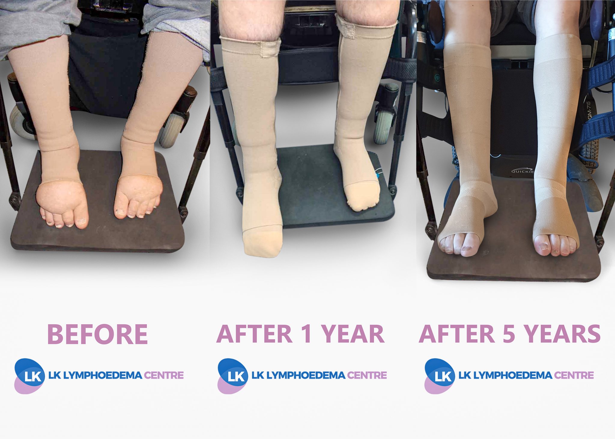 Complete Decongestive Therapy and Compression Therapy - LK Lymphoedema  Centre
